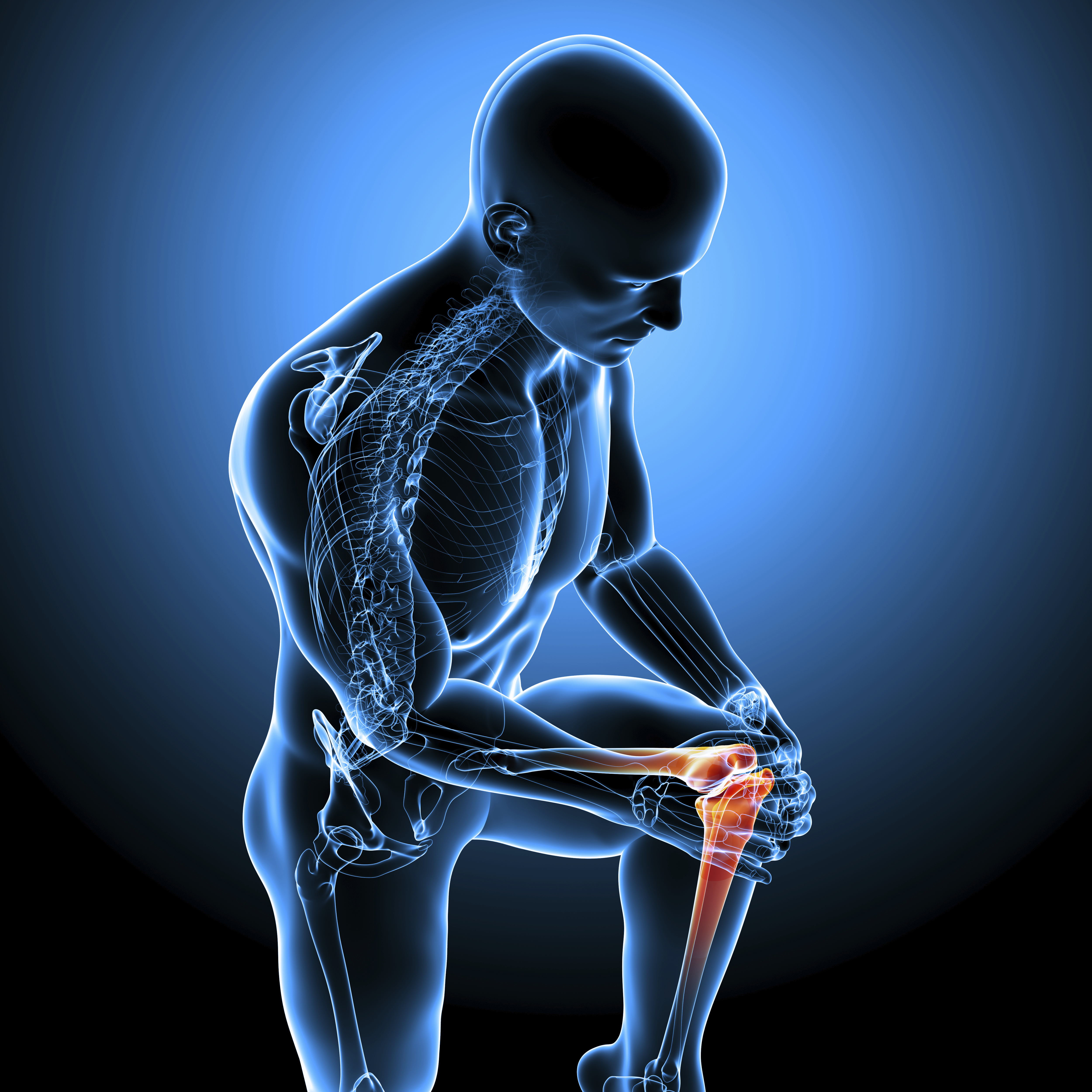 Operación de Prótesis Total de Rodilla | Artroplastia